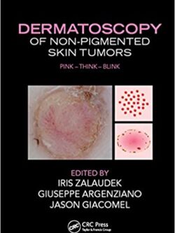 Dermatoscopy of Non-Pigmented Skin Tumors – eBook